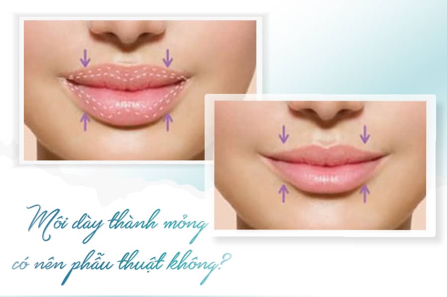 Có nên phẫu thuật môi dày thành mỏng không?