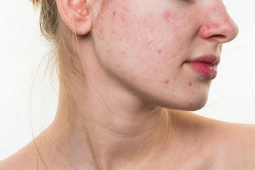 Mẹo tẩy da chết để giúp da sạch mụn