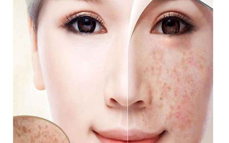 Điều trị nám công nghệ cao
