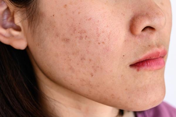 Tại sao xuất hiện nám, tàn nhang và đốm nâu?
