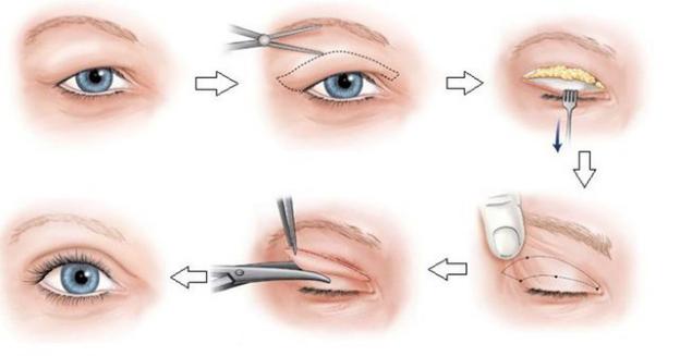 Cắt mí và cách chăm sóc để có đôi mắt đẹp