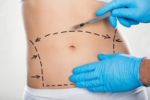 Cắt hay hút mỡ bụng tốt hơn?