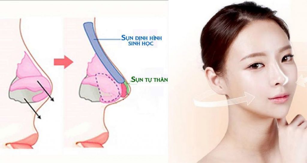Phẫu thuật nâng mũi như thế nào?