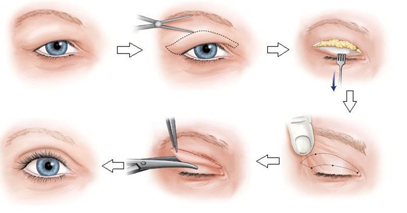 5 Phương Thức Phẫu Thuật Thẩm Mỹ Mắt