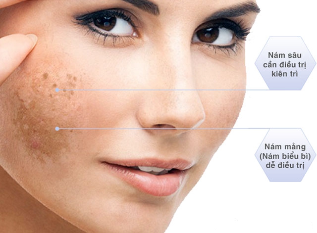 Cách Điều Trị Nám Sau Sinh