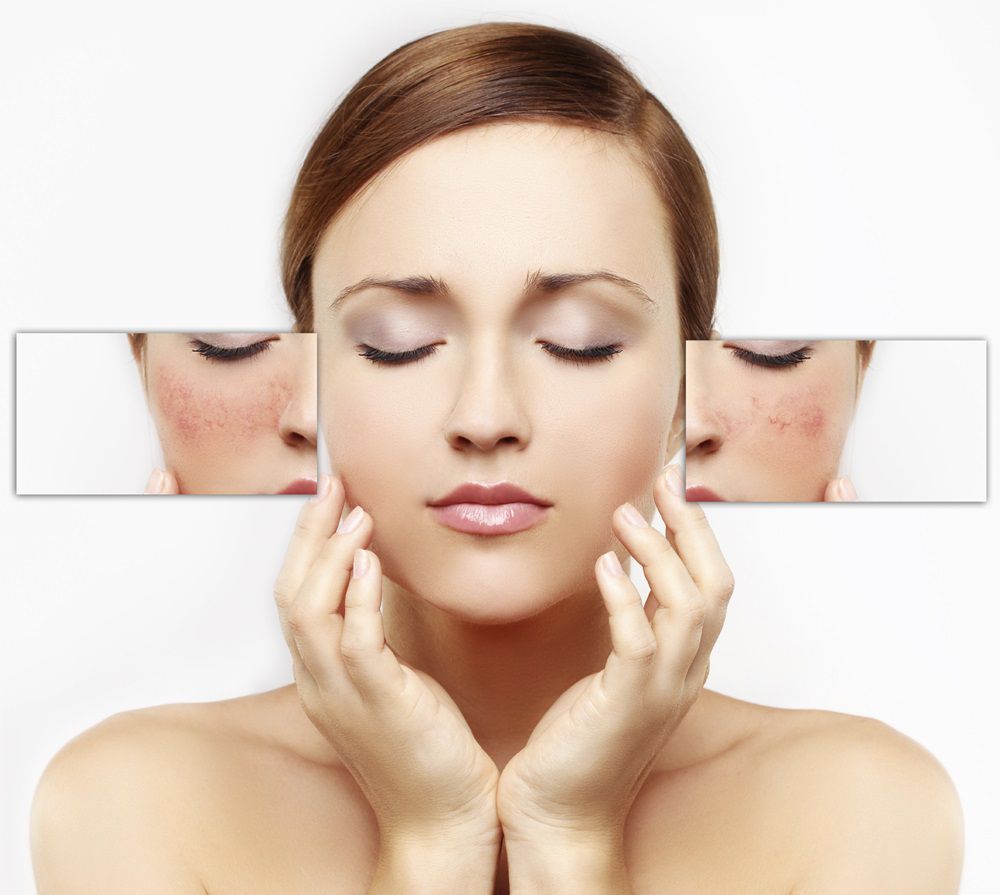 Quy trình chăm sóc phục hồi da sau khi trị mụn