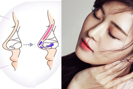 Những Điều Cần Biết về Phẫu Thuật Nâng Mũi